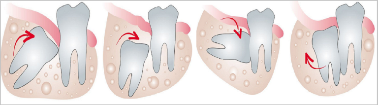 Wisdom-Tooth-extraction-Pune-768x213