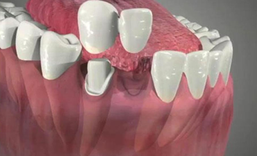 dental-cantilever