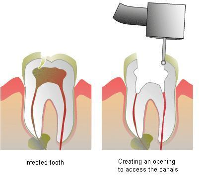 root-canal-1