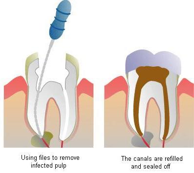 root-canal-2