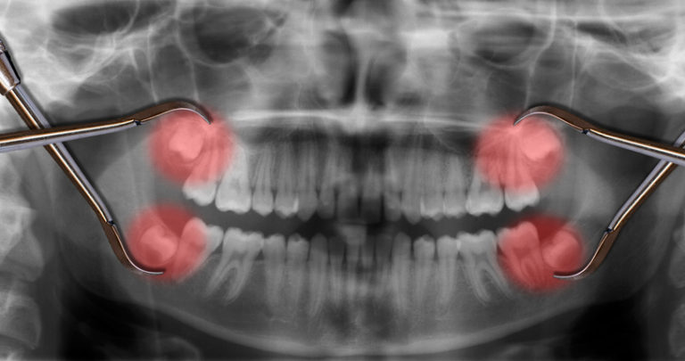 display four wisdom teeth over x-ray